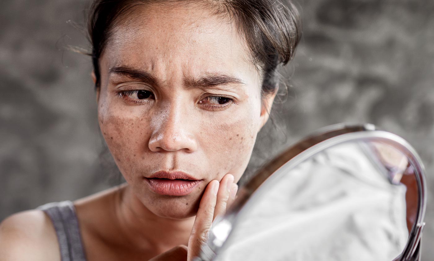 What Causes Brown Spots & How to Treat Them O Skin Med Spa